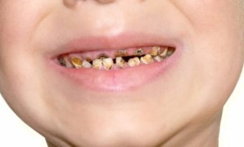 خطوات احمى بها طفلك من تسوس أسنانه اللبنية