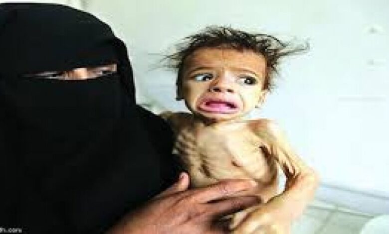مساعدات بريطانية لمنع حالات سوء التغذية في اليمن