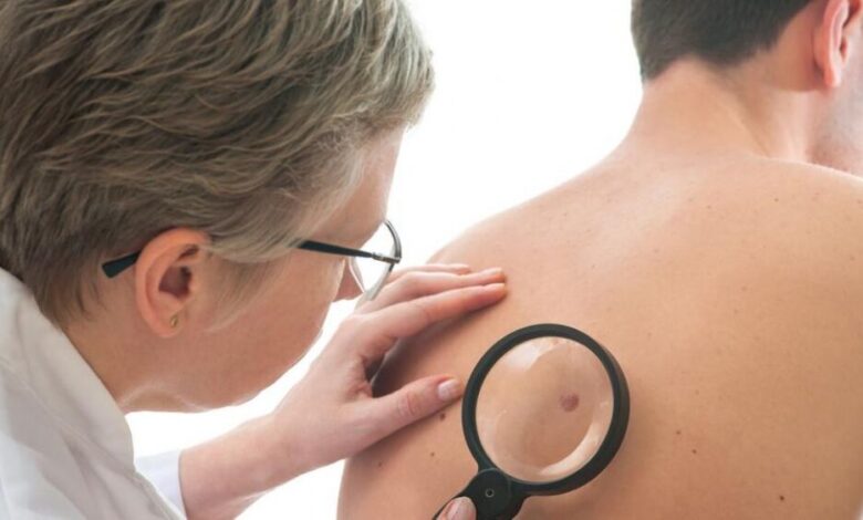 مفاجأة.. سرطان الجلد يزيد وفيات الرجال