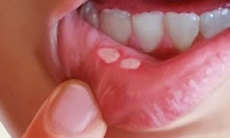 علاج قرحة الفم اهمها الشطف بمياه مالحة
