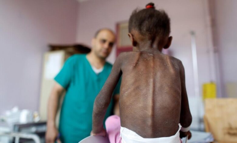 خصوصا بسوريا واليمن والسودان.. 16 مليون طفل ضحايا سوء التغذية بالشرق الأوسط وشمال أفريقيا