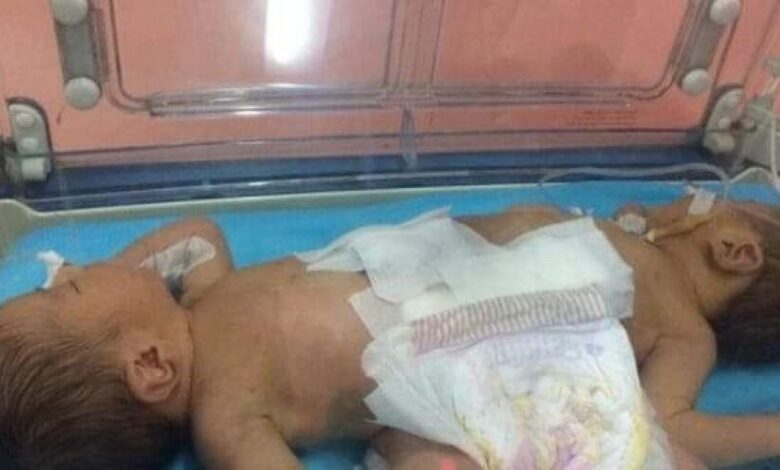 نجاح عملية فصل التوأم الليبي أحمد ومحمد..في عملية جراحية استغرقت ١٤ ساعة بالسعودية