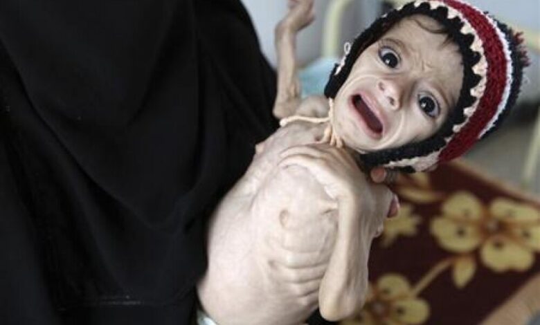 تحذيرات من تفشي سوء التغذية.. هل يفقد اليمن جيلا بأكمله؟!
