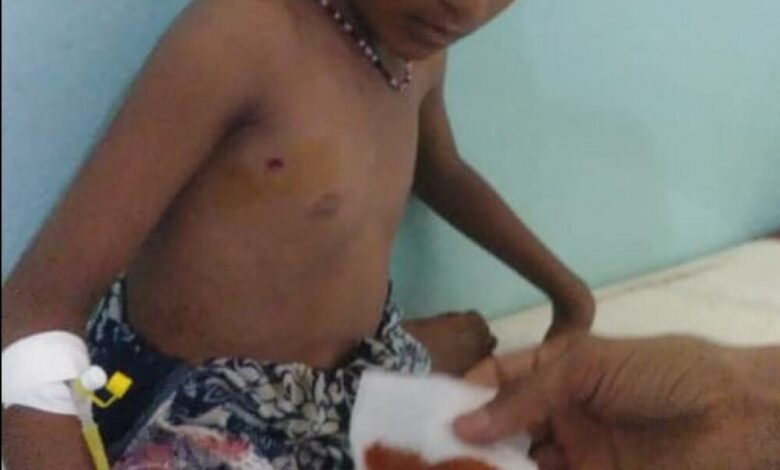 الحديدة:إستشهاد طفل وإصابة شقيقته بإنفجار قنبلة يدوية من مخلفات الحوثيين في حيس