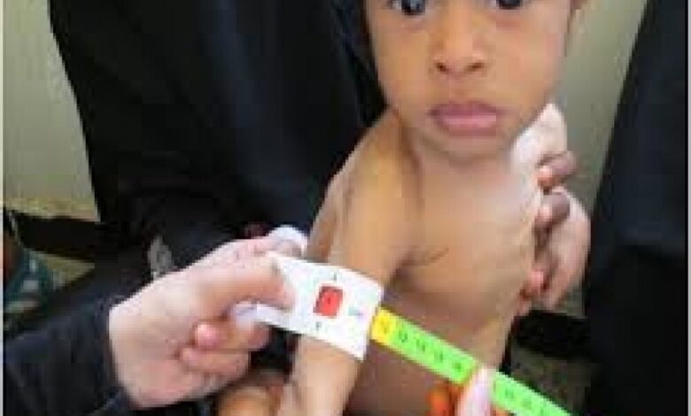الصحة العالمية تعالج 18 ألف طفل يمني من سوء التغذية الحاد.