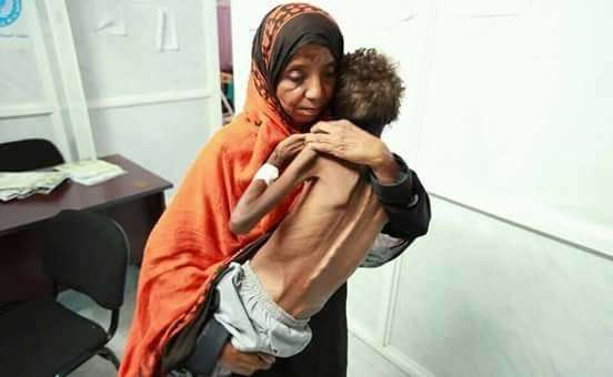 تقرير أممي يتوقع أن يتفاقم مستوى انعدام الأمن الغذائي الحاد في اليمن