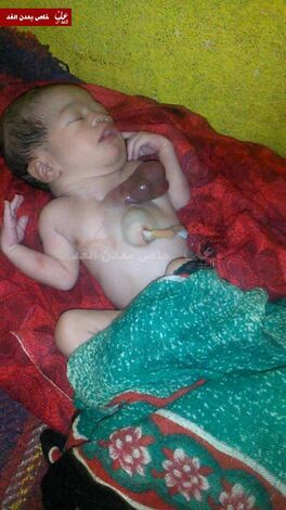 بالصور: ولادة طفلة بالصبيحة قلبها خارج جسمها