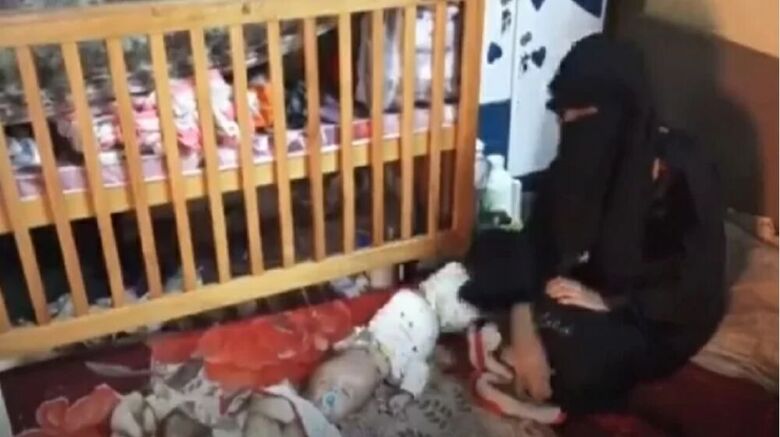 والدة التوأم السيامي اليمني: فوجئت بقرار العلاج في السعودية.. أموت أنا ويعيش أبنائي