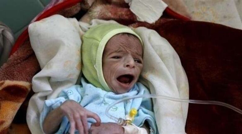 46 % من أطفال اليمن يعانون التقزم