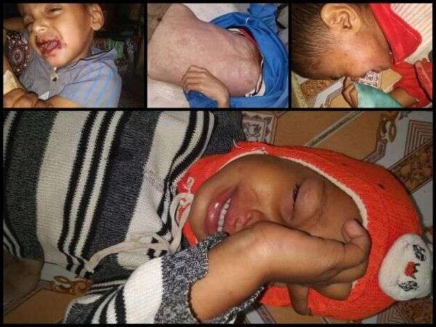 حالات وفاة.. تصاعد أعداد الإصابات بين الأطفال بداء الحصْبة في حجّة والمليشيا الحوثية تجرم اللقاح